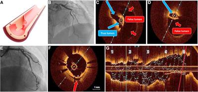 Invasive imaging modalities in a spontaneous coronary artery dissection: when “believing is seeing”